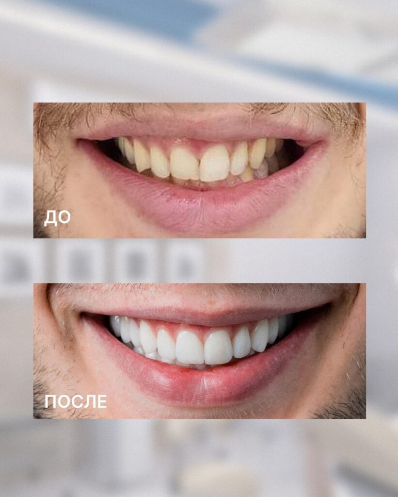 Зубы до установки виниров и после