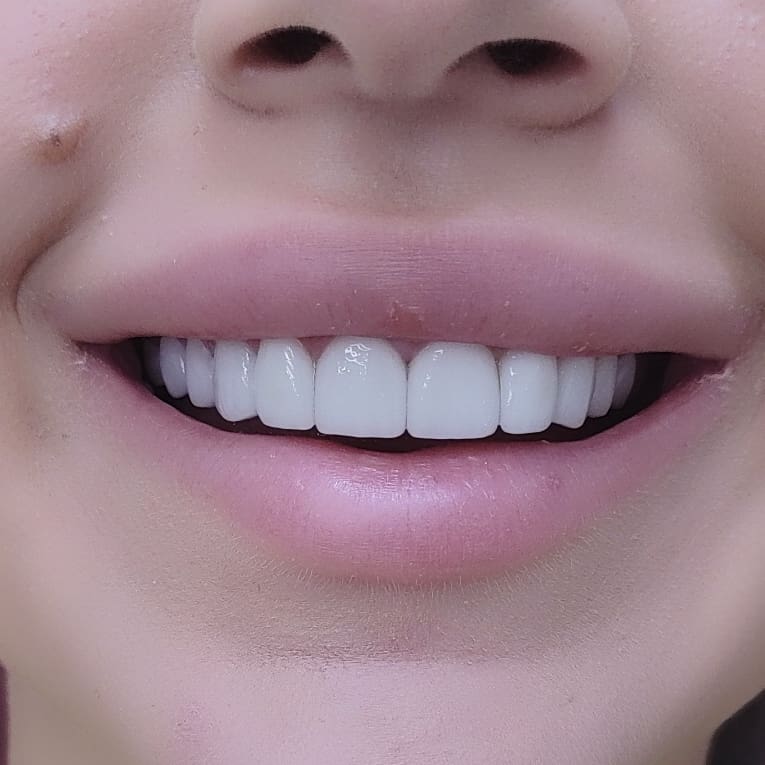 Керамические виниры цвета bleach 1 - после установки