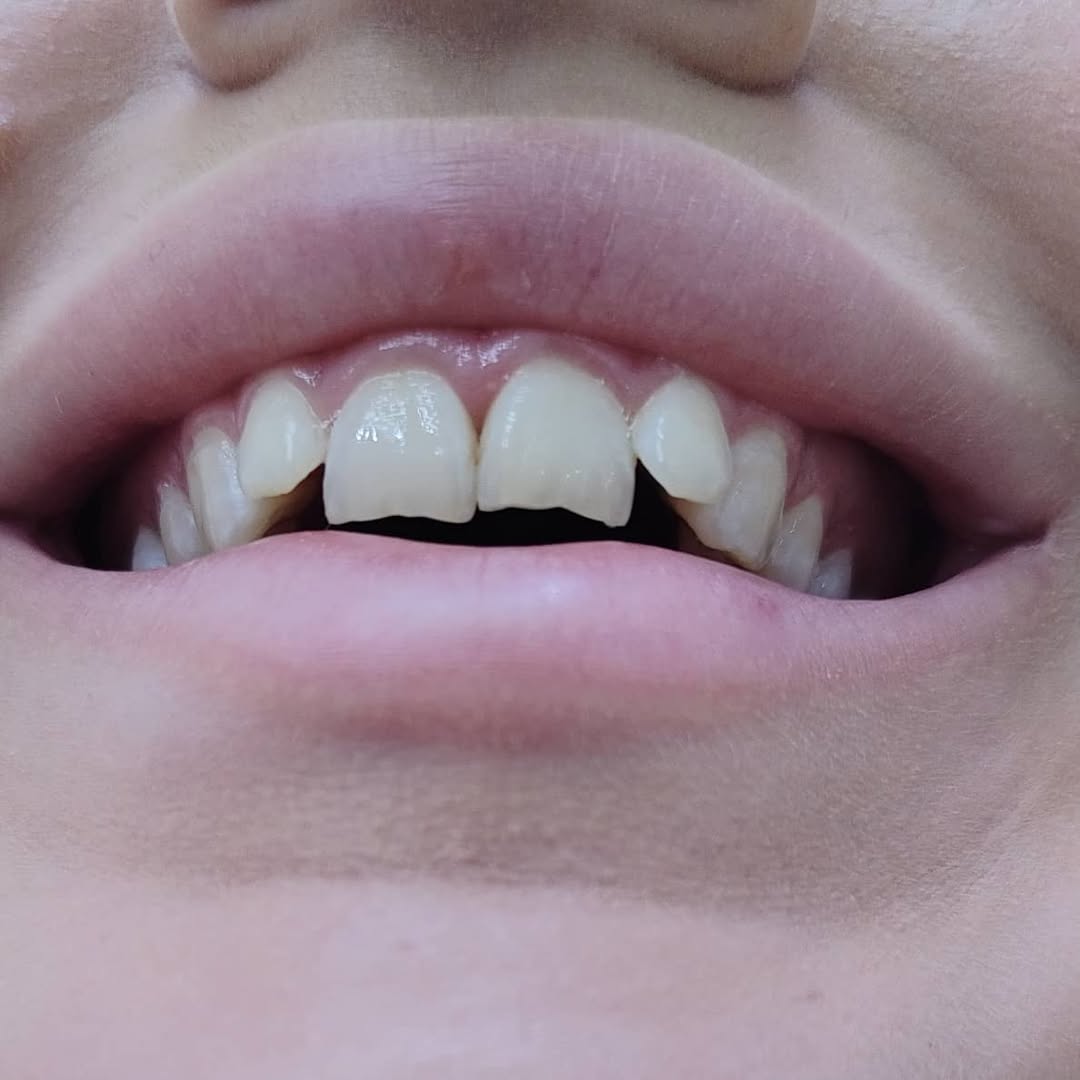 Керамические виниры цвета bleach 1 - до установки