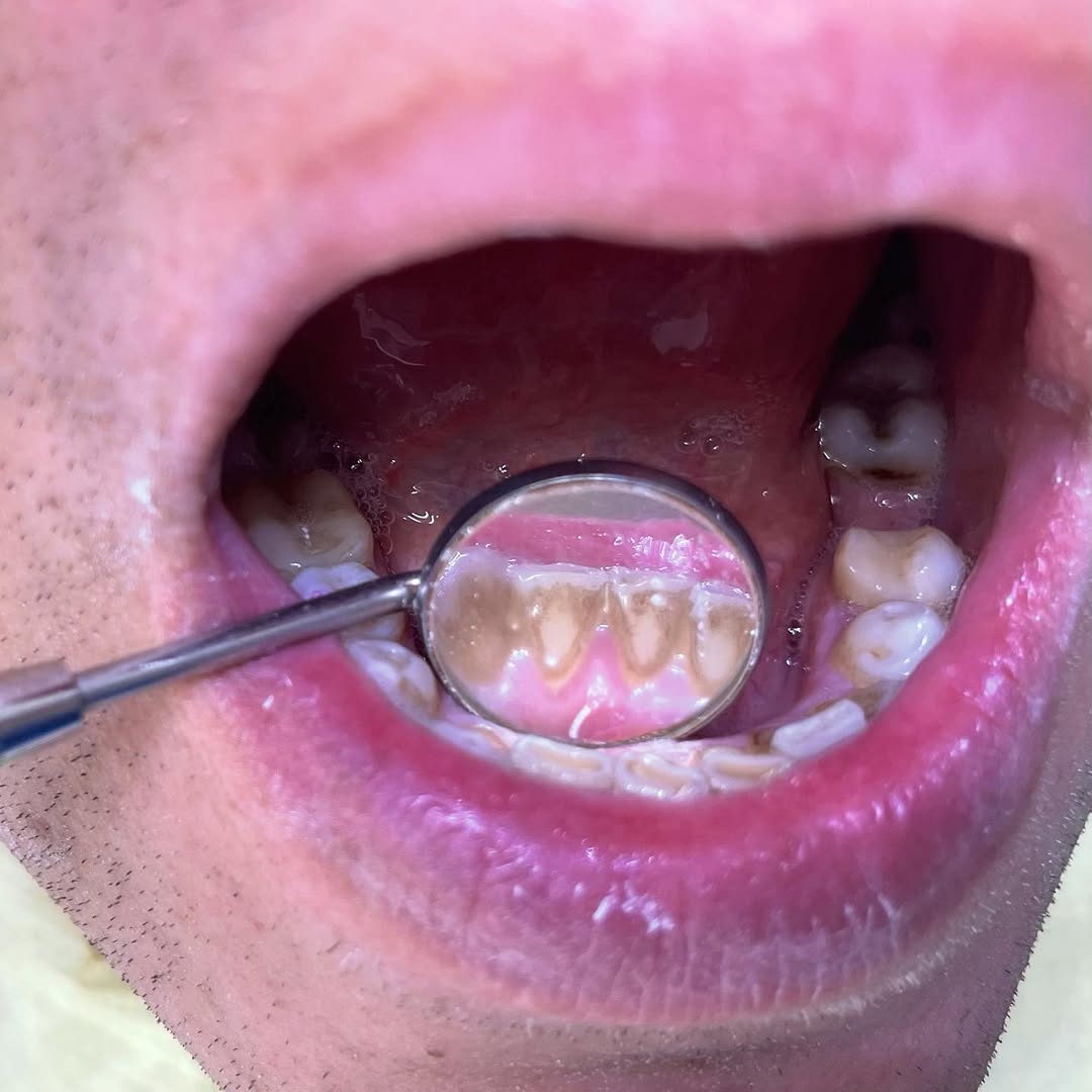 Чистка зубов, до и после 2