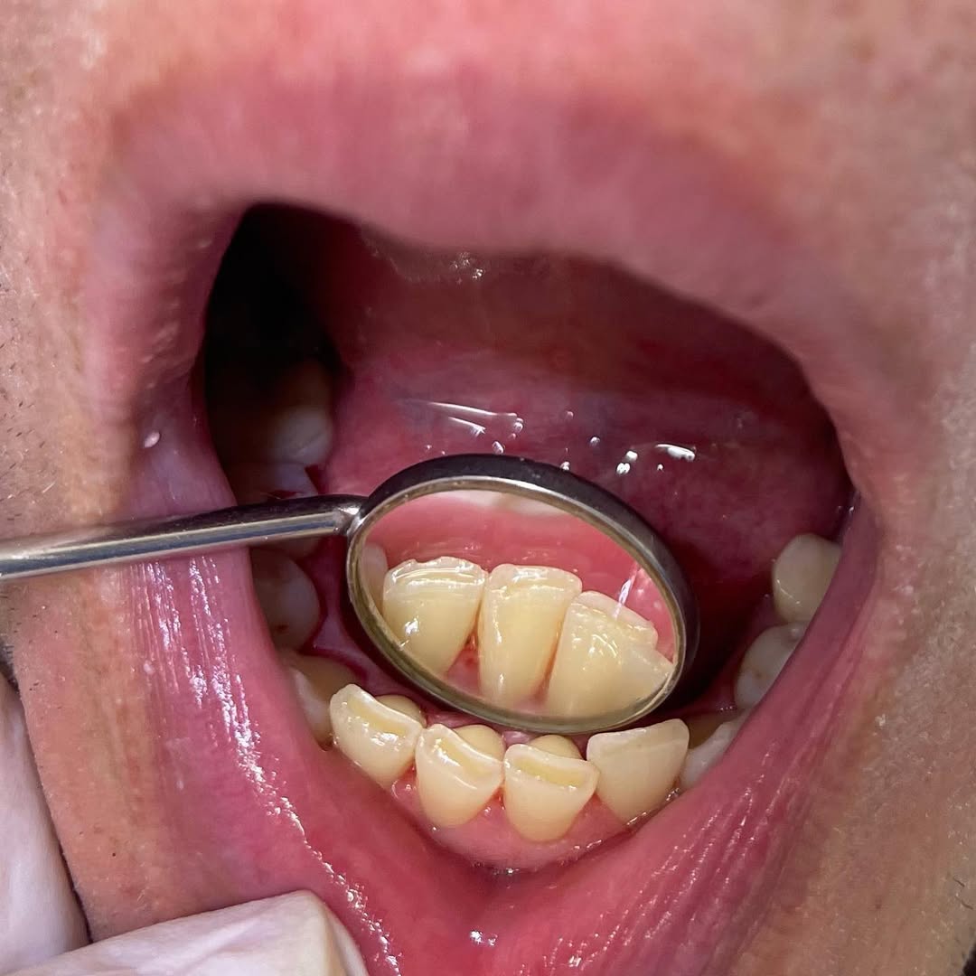 Чистка зубов, до и после 3